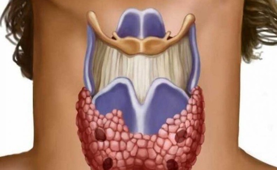 Узловой зоб щитовидной железы - лечение, операция